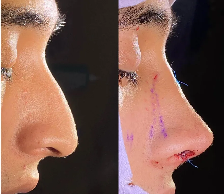 Perfil · antes e pós-operatório imediato
