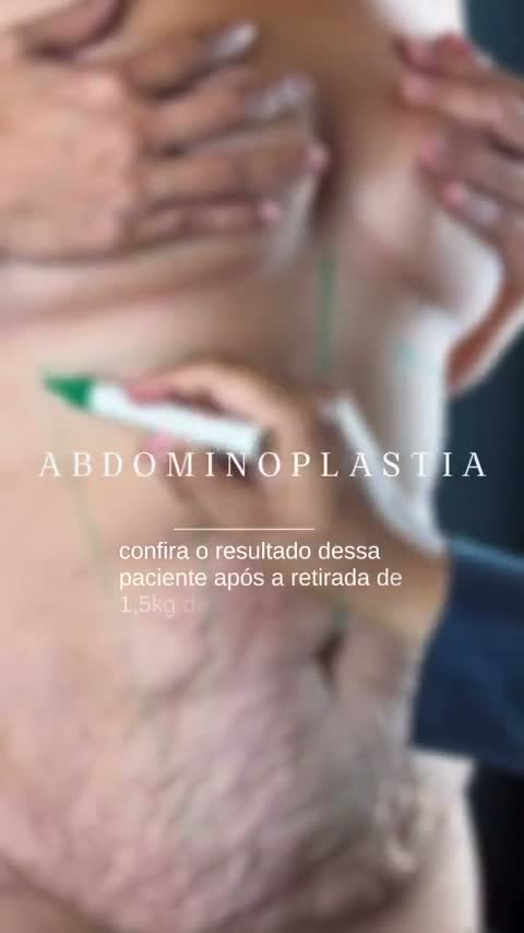 Abdominoplastia: 1,5kg de pele removida