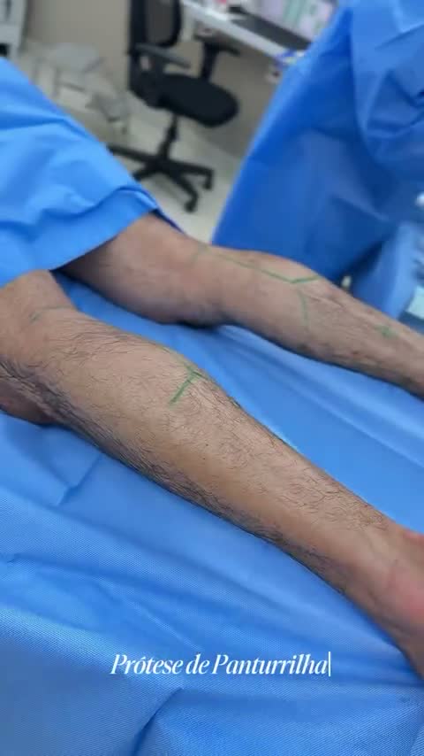 Lipo de panturrilha